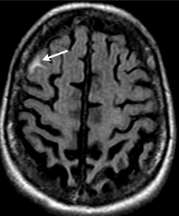 MRI scan waarop een ARIA zichtbaar is